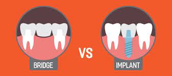 implant-vs-bridge