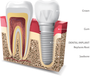 implant to replace one tooth