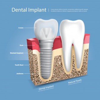 what is a dental implant