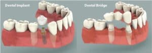 Puente vs implante dental