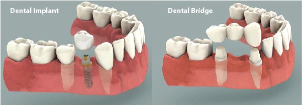 dental bridge vs implant