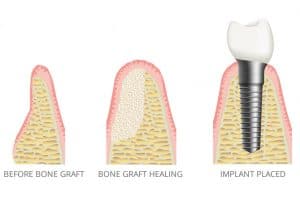 bone graft for implant