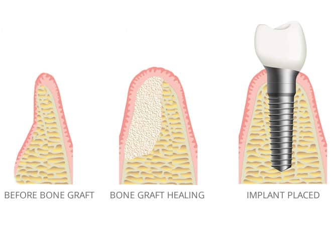 What happens if you don't get a bone graft?