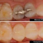 Mercury release amalgam fillings during teeth clenching