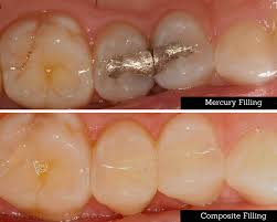 amalgam removal cost