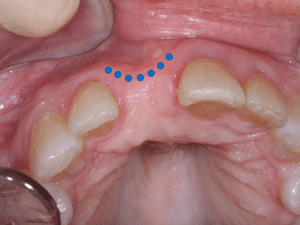 Bone Graft Surgery Necessary For A Dental Implant