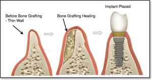 bone graft necessary for dental implant