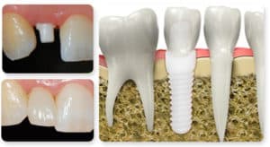 average dental implant healing time