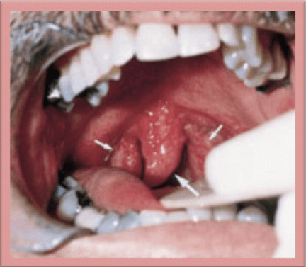 Enlarged Uvula