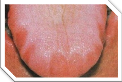 tongue sleep apnea
