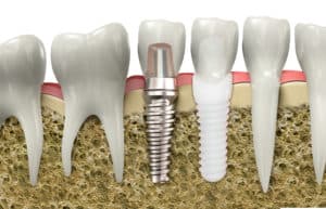Qué es el mejor implante dental
