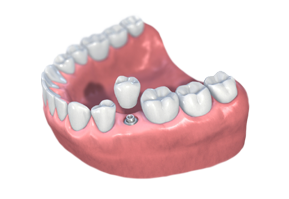 single tooth implant
