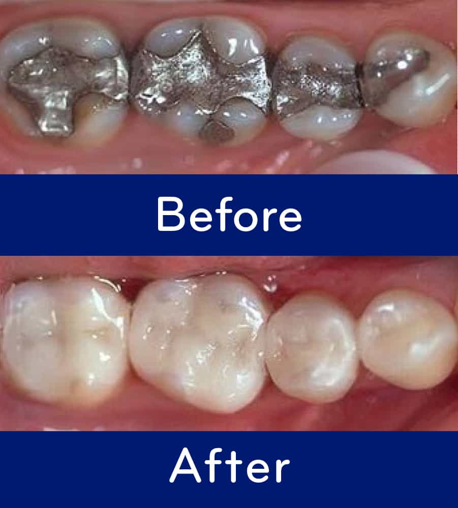 Cavity Fillings: The Difference Between White Fillings & Silver Fillings