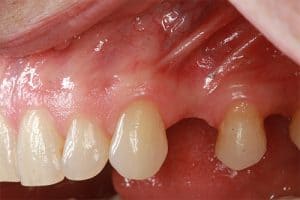 missing teeth causes bone loss