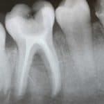 dentista del retiro del canal de raíz