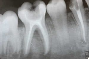 biological root canal removal process