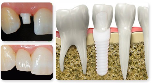 zirconia dental implants