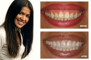 porcelain veneers