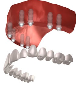 full mouth of dental implants