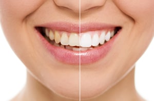 porcelain-dental-crowns-maryland-300x198