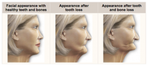 dental implants bone loss