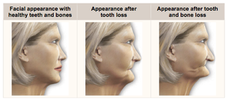 dental implants healing time line