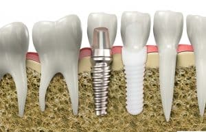 zirconia zeeramex xt implant