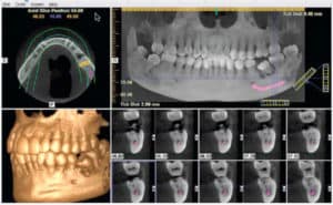 removing wisdom teeth necessary