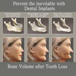 types of bone grafts