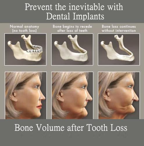 does osteoporosis affect jaw bone