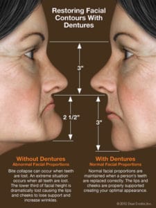 bone grafting before and after