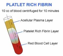 Fibrina rica en plaquetas PRF con cirugía de implantes dentales