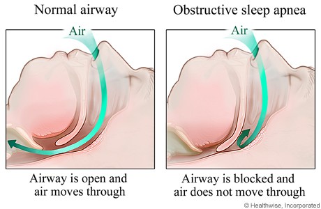 sleep apnea tmj link