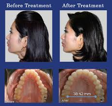 Dispositivos dentales para la apnea del sueño, lo que debes saber