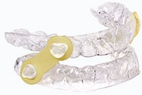 sleep apnea dentist appliance