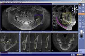 Haz de conos Cone Scan