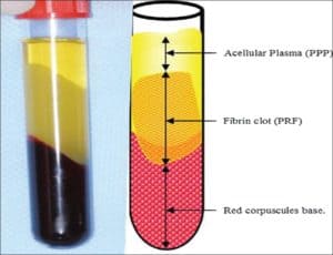 platelet rich fibrin dental implants