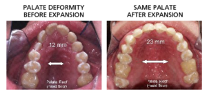 before and after palatal expansion