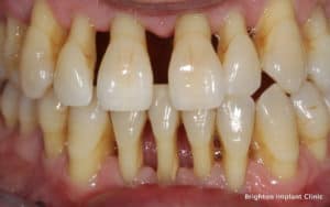 severe gum disease