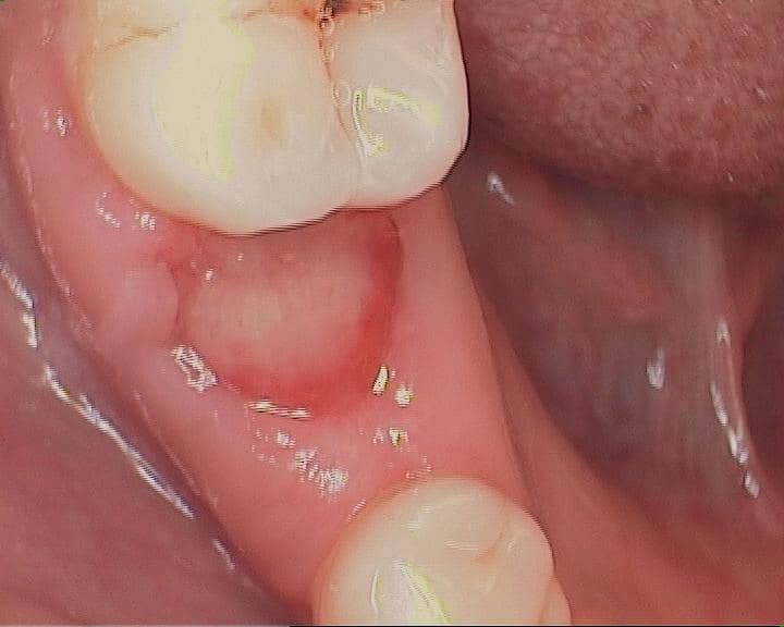 wisdom tooth implant post op care instructions