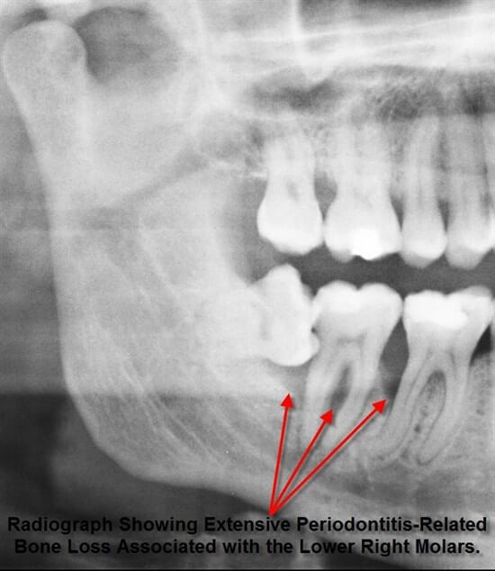 wisdom teeth removal