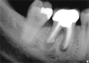 Bone graft necessary for implant