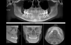 Especialista en implantes