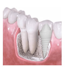 root canal or implant