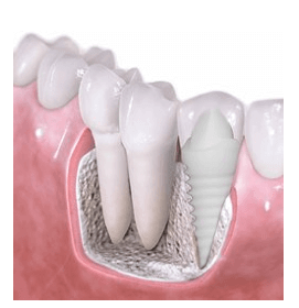 what is a dental implant