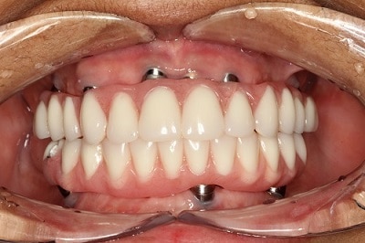 same day all on 4 full implants