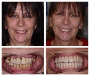 full mouth dental implants before and after