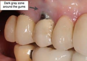 dental implant complications