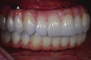 all on 4 implant teeth