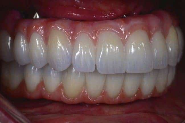 Full Mouth Zirconia Implants Before and After